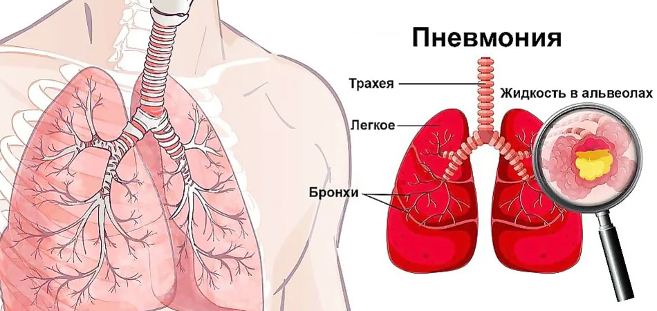 Инфографика Пневмония