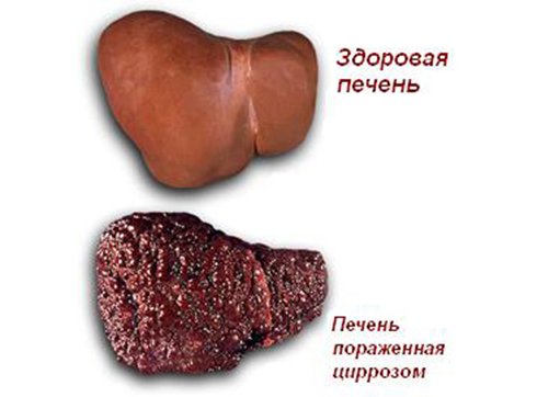 Что такое алкогольная болезнь печени Вид здоровой и больной печени